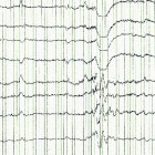 Elektro-encefalografie (EEG)