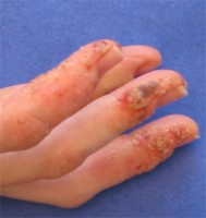  De kris in contact met de huid kan een jeukende huid t.g.v. nikkelallergie veroorzaken  / Bron: Dbnull, Wikimedia Commons (Publiek domein)